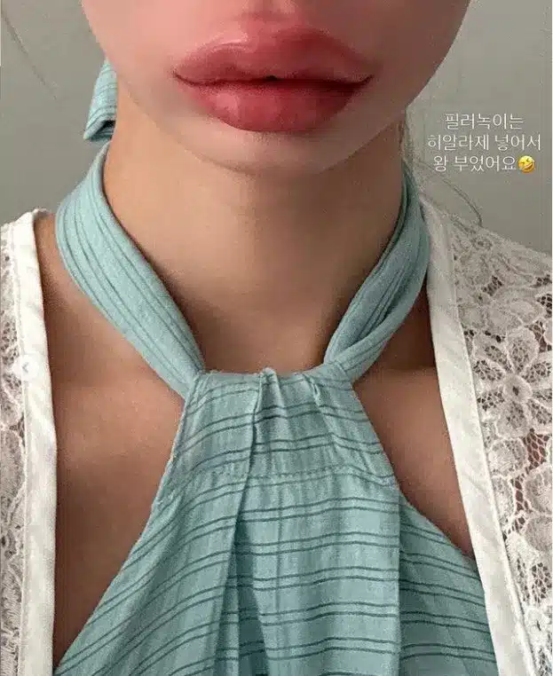 Comedian Maeng Seung-ji Shares Post-Filler Removal Update Comedian Maeng Seung-ji Shares Post-Filler Removal Update